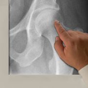 Hip Fracture Injury